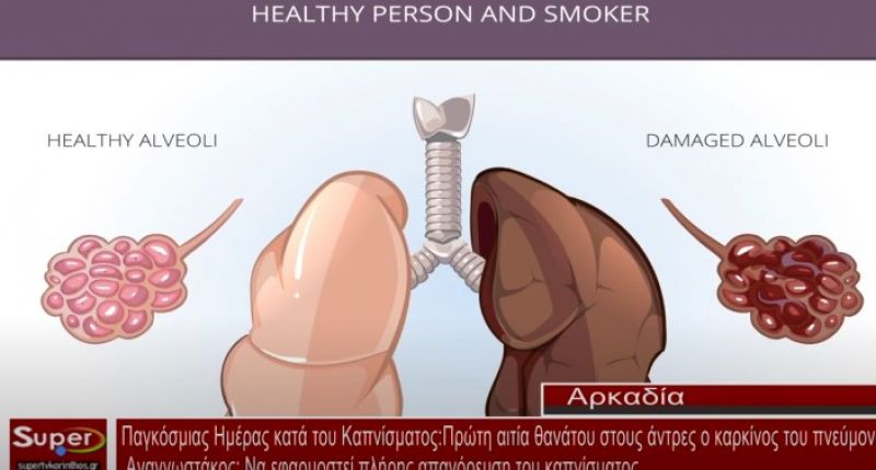 Παγκόσμιας Ημέρας κατά του Καπνίσματος:Πρώτη αιτία θανάτου στους άντρες ο καρκίνος του πνεύμονα  (video)
